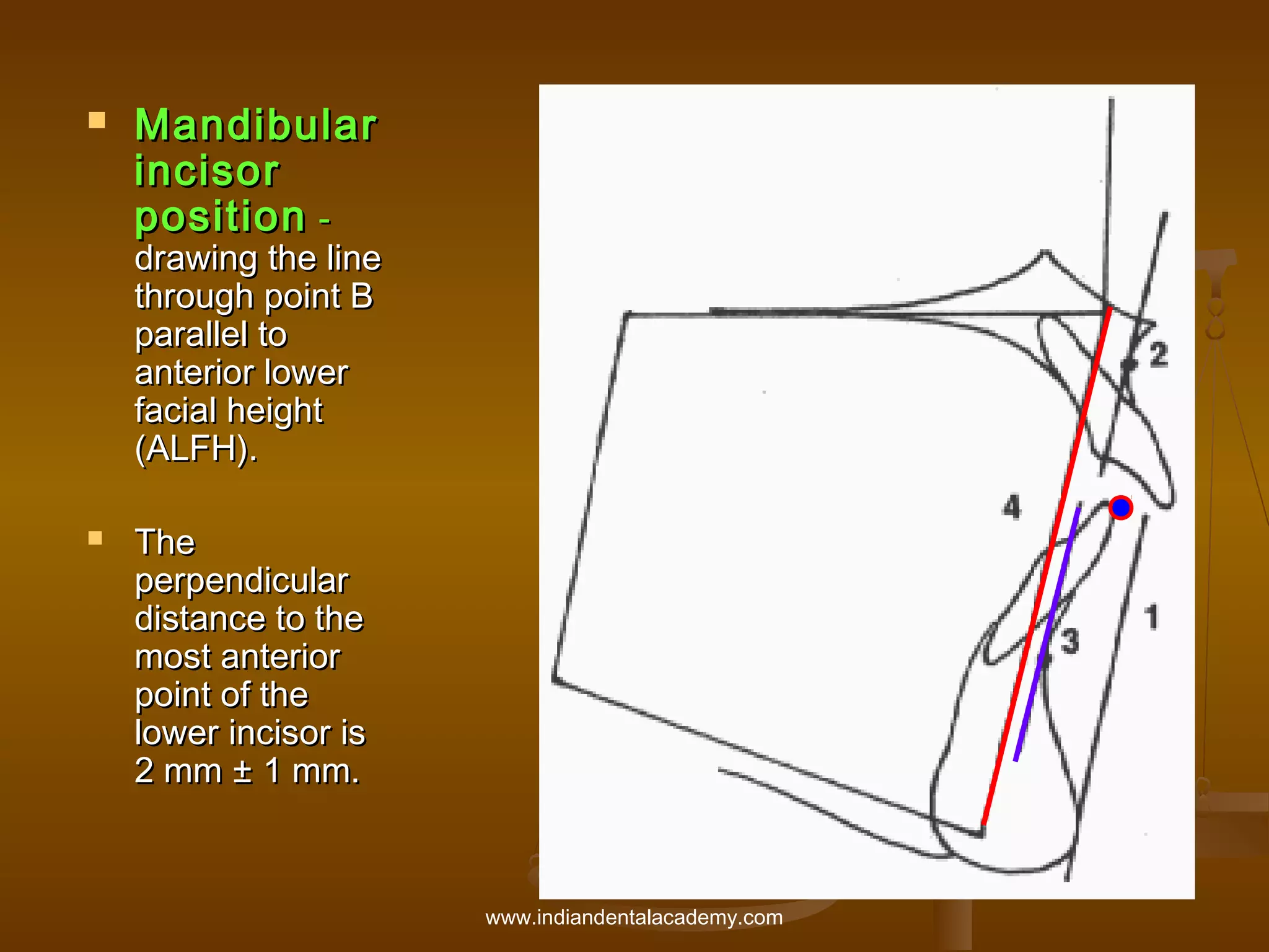 

Mandibular
incisor
position -

drawing the line
through point B
parallel to
anterior lower
facial height
(ALFH).


The
perpendicular
distance to the
most anterior
point of the
lower incisor is
2 mm ± 1 mm.

www.indiandentalacademy.com

 