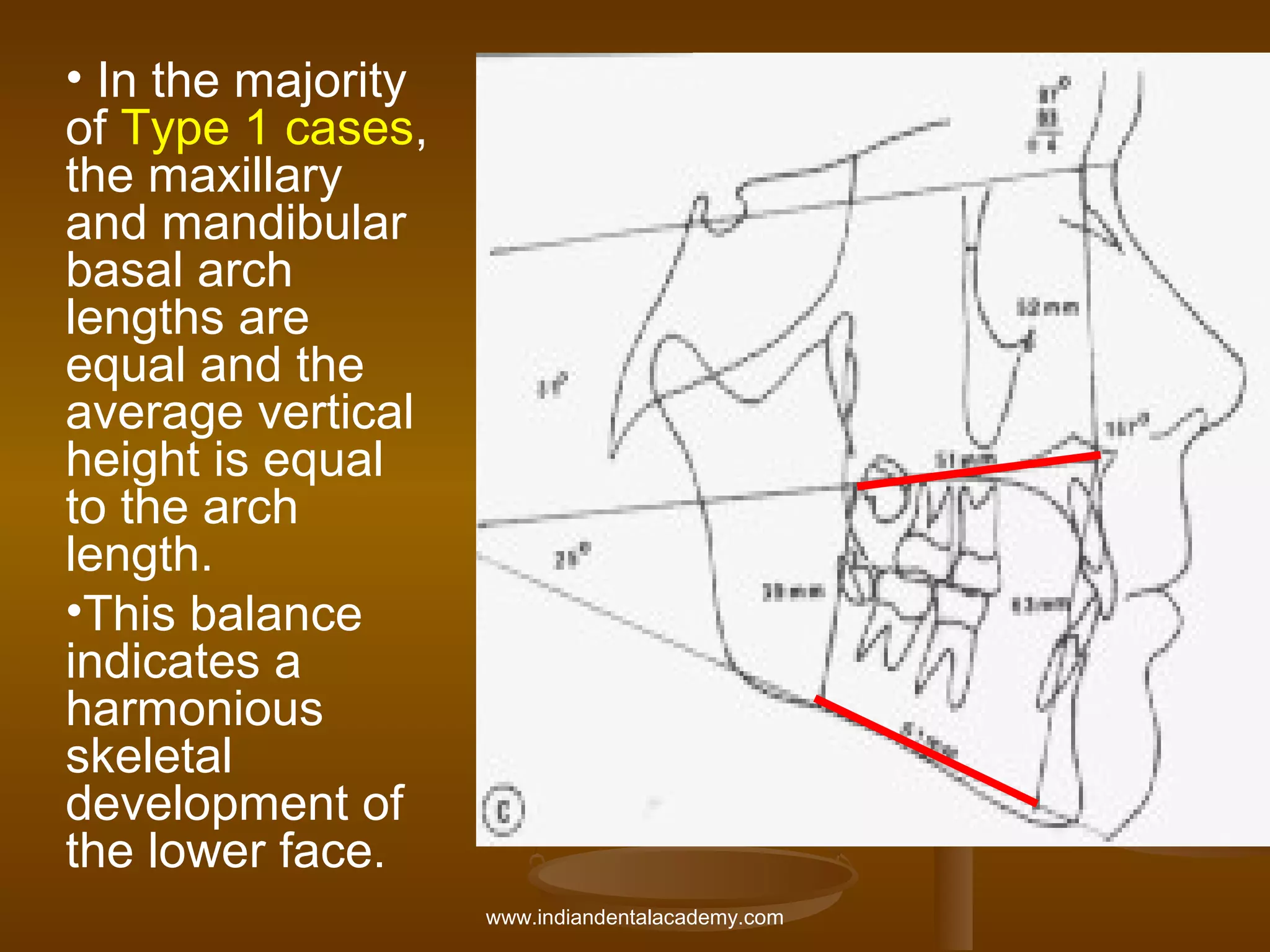 • In the majority
of Type 1 cases,
the maxillary
and mandibular
basal arch
lengths are
equal and the
average vertical
height is equal
to the arch
length.
•This balance
indicates a
harmonious
skeletal
development of
the lower face.
www.indiandentalacademy.com

 