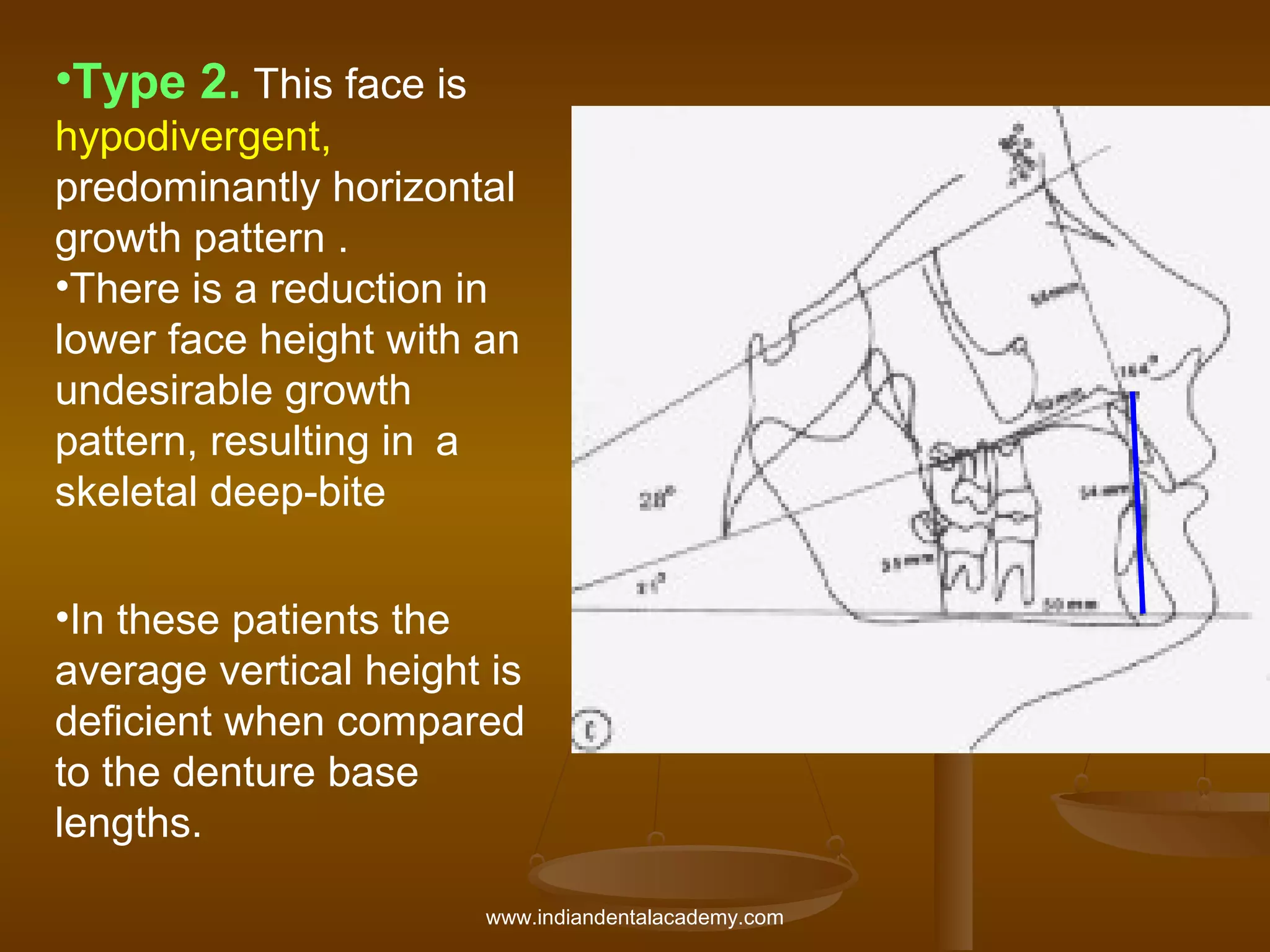 •Type 2. This face is
hypodivergent,
predominantly horizontal
growth pattern .
•There is a reduction in
lower face height with an
undesirable growth
pattern, resulting in a
skeletal deep-bite
•In these patients the
average vertical height is
deficient when compared
to the denture base
lengths.
www.indiandentalacademy.com

 