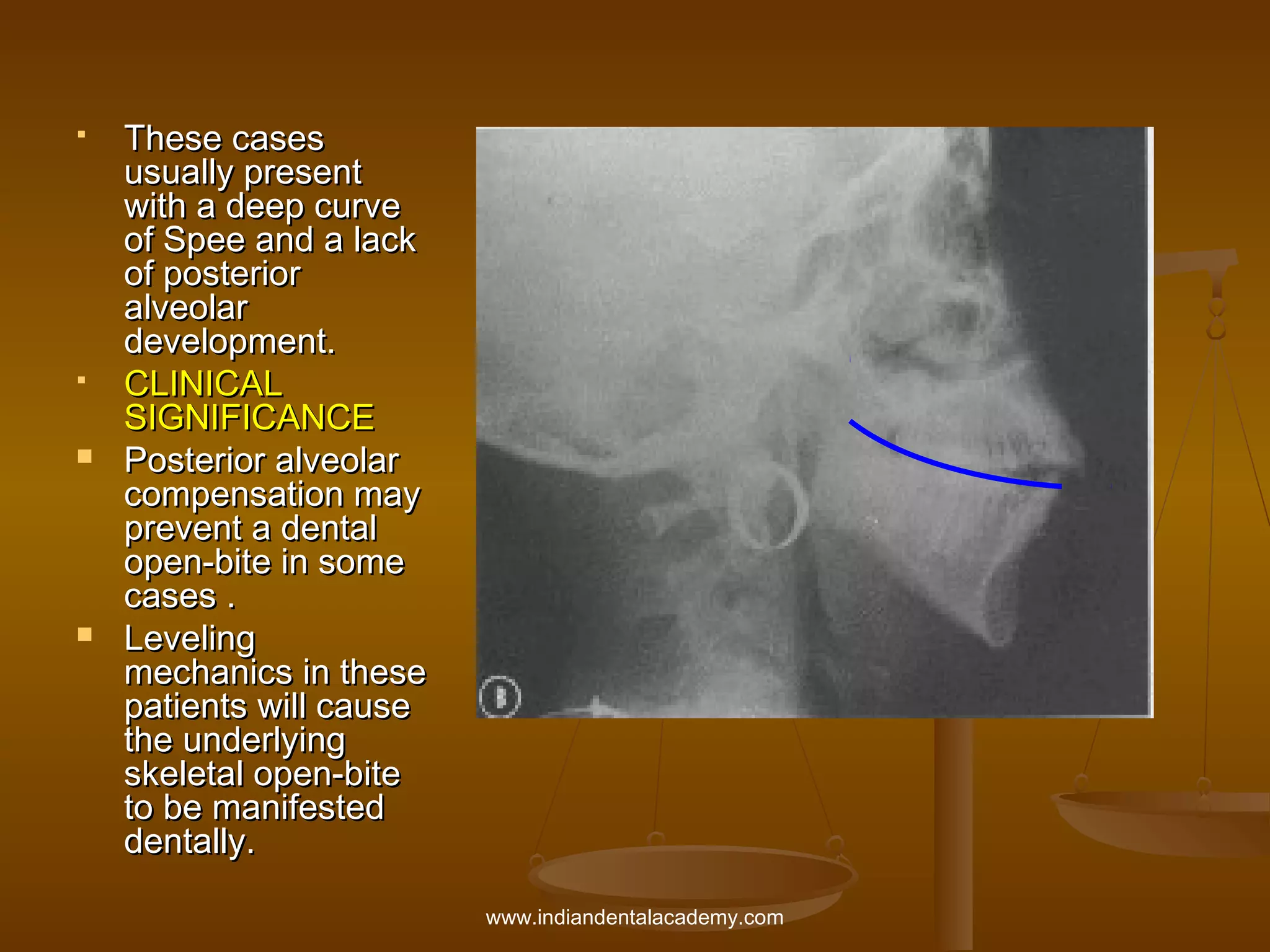 






These cases
usually present
with a deep curve
of Spee and a lack
of posterior
alveolar
development.
CLINICAL
SIGNIFICANCE
Posterior alveolar
compensation may
prevent a dental
open-bite in some
cases .
Leveling
mechanics in these
patients will cause
the underlying
skeletal open-bite
to be manifested
dentally.
www.indiandentalacademy.com

 