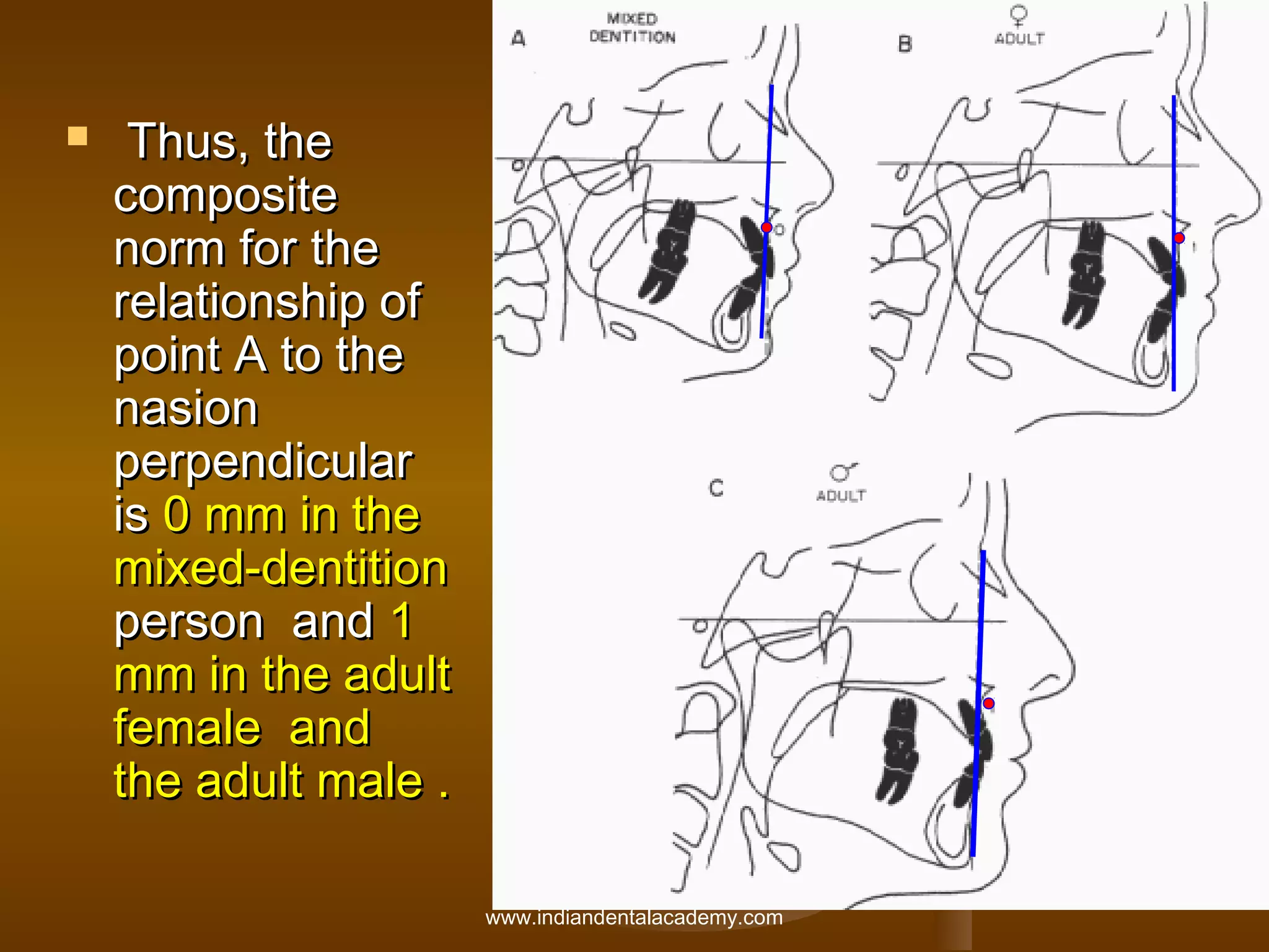 

Thus, the
composite
norm for the
relationship of
point A to the
nasion
perpendicular
is 0 mm in the
mixed-dentition
person and 1
mm in the adult
female and
the adult male .
www.indiandentalacademy.com

 