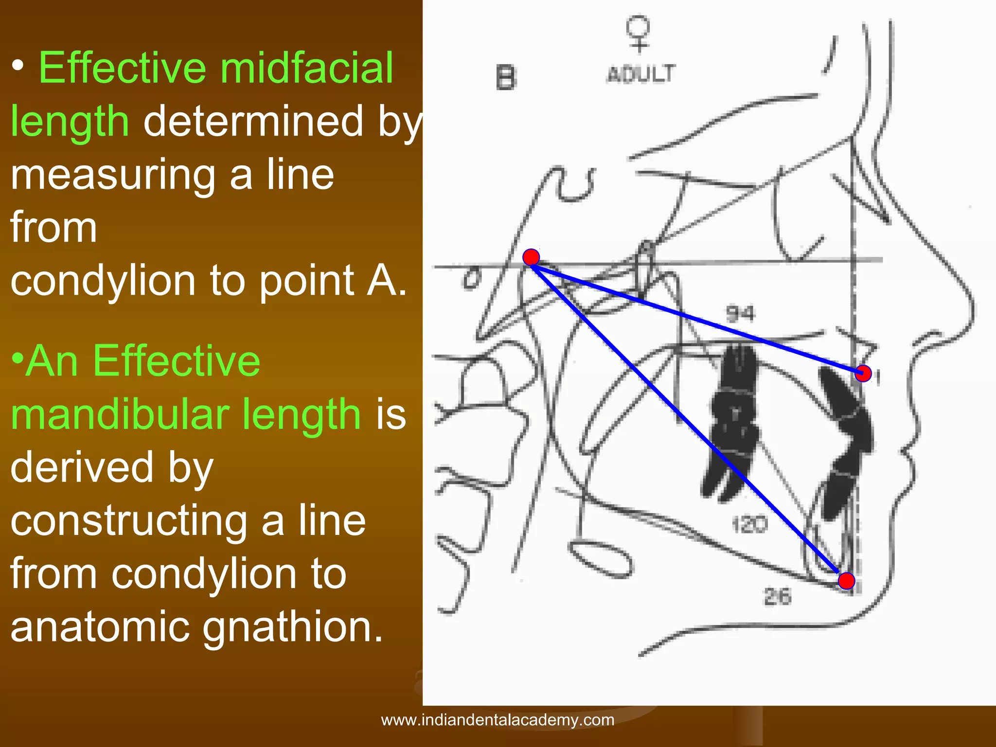 • Effective midfacial
length determined by
measuring a line
from
condylion to point A.
•An Effective
mandibular length is
derived by
constructing a line
from condylion to
anatomic gnathion.
www.indiandentalacademy.com

 