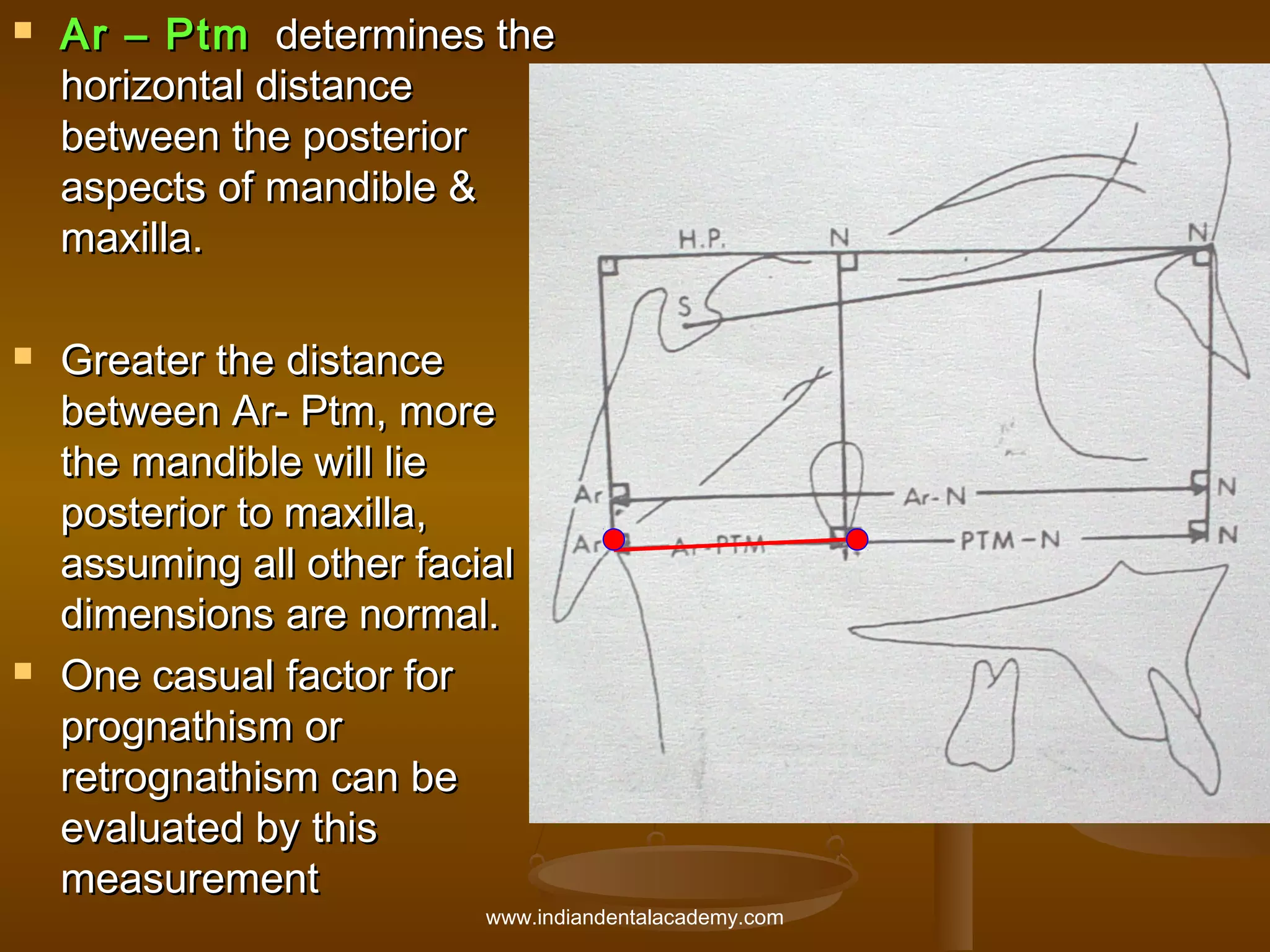 





Ar – Ptm determines the
horizontal distance
between the posterior
aspects of mandible &
maxilla.
Greater the distance
between Ar- Ptm, more
the mandible will lie
posterior to maxilla,
assuming all other facial
dimensions are normal.
One casual factor for
prognathism or
retrognathism can be
evaluated by this
measurement

www.indiandentalacademy.com

 