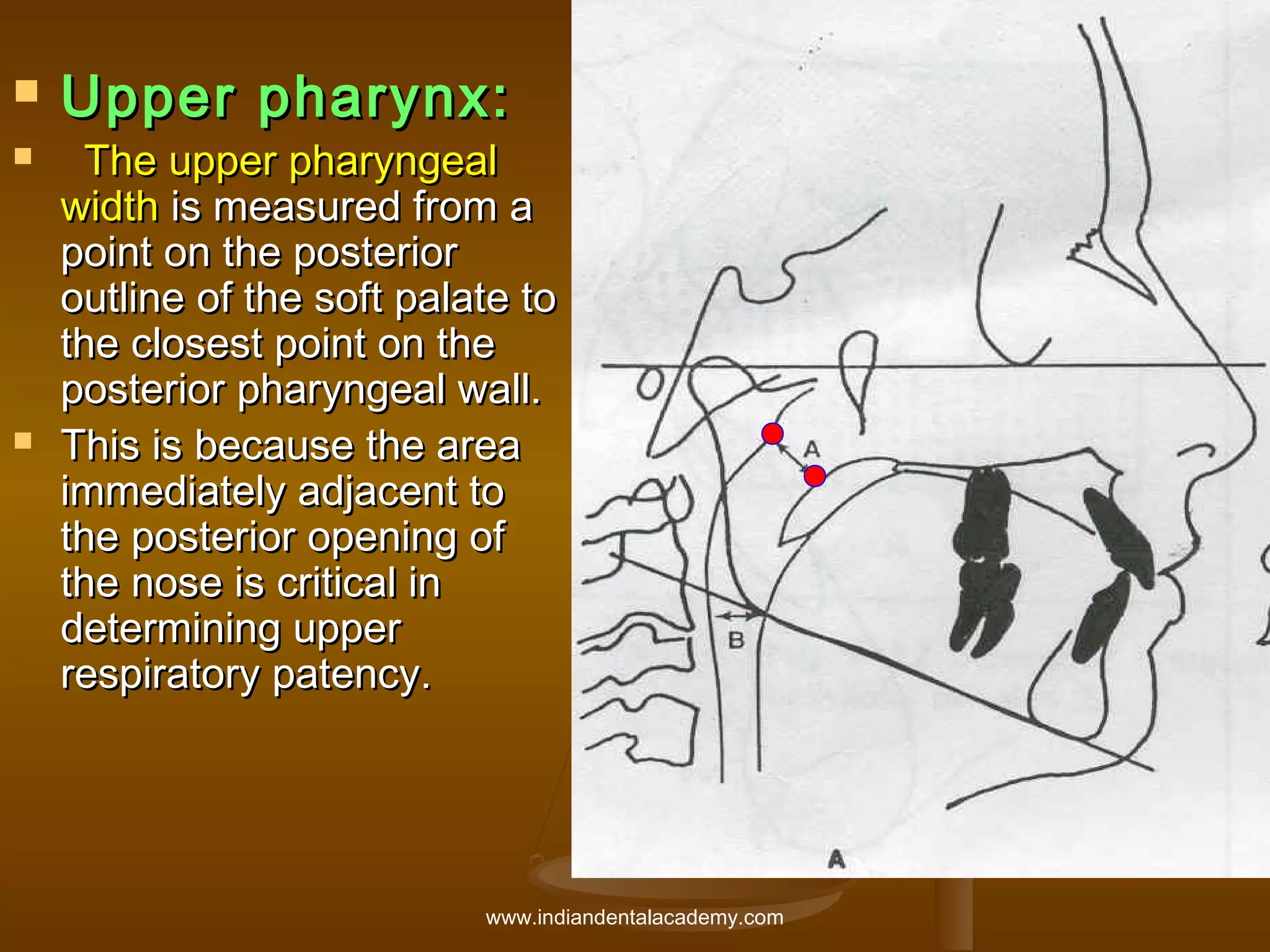 




Upper pharynx:

The upper pharyngeal
width is measured from a
point on the posterior
outline of the soft palate to
the closest point on the
posterior pharyngeal wall.
This is because the area
immediately adjacent to
the posterior opening of
the nose is critical in
determining upper
respiratory patency.

www.indiandentalacademy.com

 