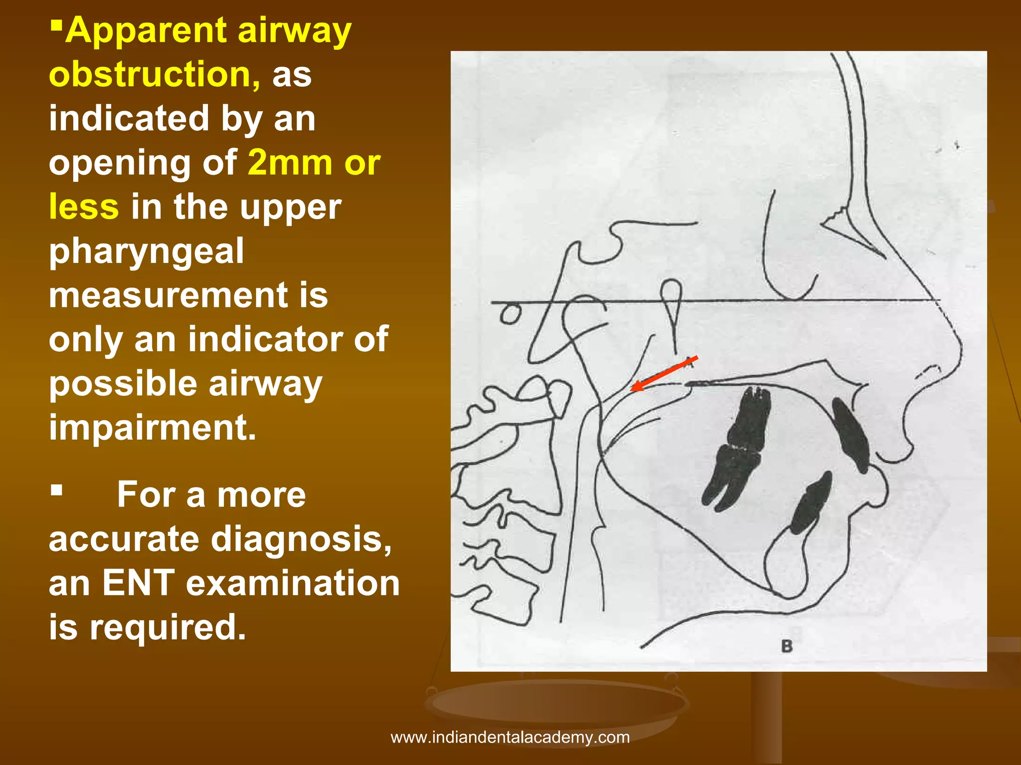 Apparent airway
obstruction, as
indicated by an
opening of 2mm or
less in the upper
pharyngeal
measurement is
only an indicator of
possible airway
impairment.
 For a more
accurate diagnosis,
an ENT examination
is required.
www.indiandentalacademy.com

 