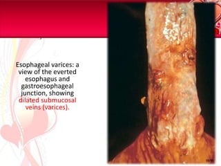 Esophageal varices: a view of the everted esophagus and gastroesophageal junction, showing dilated submucosal veins (varices). 15/81