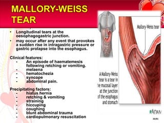 MALLORY-WEISS TEARLongitudinal tears at the oesophagogastric junction.may occur after any event that provokes a sudden rise in intragastric pressure or gastric prolapse into the esophagus. Clinical features:	-	An episode of haematemesis		following retching or vomiting.	-	melaena	-	hematochezia	-	syncope	-	abdominal pain.Precipitating factors:	-	hiatus hernia			-	retching & vomiting		-	straining	-	hiccuping	-	coughing	-    	blunt abdominal trauma 	-    	cardiopulmonary resuscitation20/81