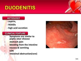 GASTRIC CANCER: TNM STAGINGTT1		tumour extends to lamina propria or submucosa.T2		tumour extend into muscleT3		tumour extend into serosaT4		tumour invades adjacent structuresN0		no lymph node involvementN1		fewer than 7 lymph node involved by tumourN2		7-15 lymph node involved by tumourN3		more than 15 lymph node involved by tumourM0	no metastasesM1	metastases presentNM36/81