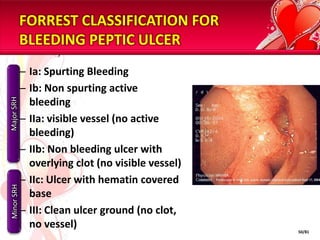 HISTORY TAKING	-	when?	-	have u vomited blood/passed black tarry stools?	-	had both haematemesis & malaena?	-	have u had, bleeding from the nose? Bloody 	expectoration? A dental extraction?-what is the color, the appearance of the vomited 	blood?	-	red? Dark red? Brown? Black?	-	‘coffee ground appearance?	-	bright red & frothy?	-	what is the color of the stool? Bright red? Black 	tarry?	-	have u vomited blood only once/several times?	-	has the bleeding been abrupt/massive?	-	have u had >1 black, tarry stool within a 24-h 	period?	-	for how long have the tarry stools persisted?MODE OF ONSETCHARACTEREXTENT AND RATE41/81