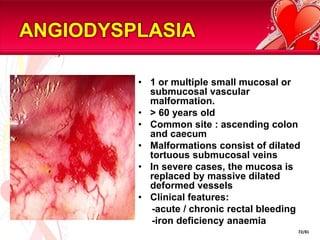 Acute Upper Gastrointestinal BleedRoutine Blood TestResuscitation and Risk AssessmentEndoscopy (within 24 hrs)VaricesPeptic UlcerNo obvious causeMajor SRHMinor SRHMinor BleedMajor BleedManagement VaricesEradicate H.pylori & Risk ReductionEndoscopic TreatmentOther colonoscopy or angiographyFailureOVERVIEW:MANAGEMENT OF UPPER GI BLEEDSurgical46/81