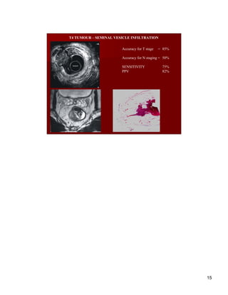 T4 TUMOUR – SEMINAL VESICLE INFILTRATION

                       Accuracy for T stage   = 85%

                       Accu...