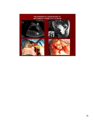 TRANSPERINEAL SONOGRAPHY IN
RECURRENT ANORECTAL TUMOUR




                              18
 