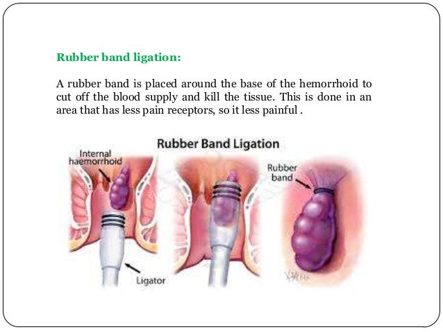 What is involved in the hemorrhoid banding procedure?