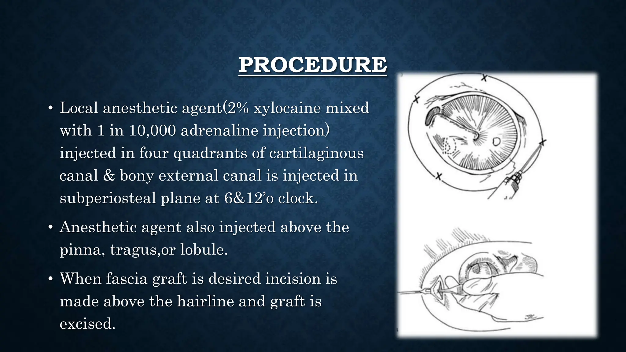 surgeries of ear.pptx