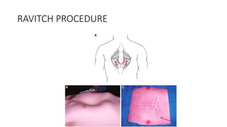 Ravitch Incision Surgeries of thorax | PPTX