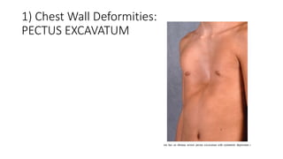 Surgeries of thorax | PPTX