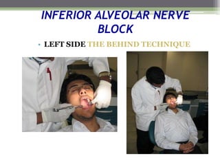 INFERIOR ALVEOLAR NERVE
BLOCK
• LEFT SIDE THE BEHIND TECHNIQUE
 