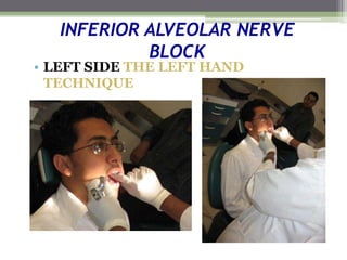 INFERIOR ALVEOLAR NERVE
BLOCK
• LEFT SIDE THE LEFT HAND
TECHNIQUE
 