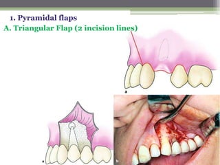 1. Pyramidal flaps
A. Triangular Flap (2 incision lines)
 