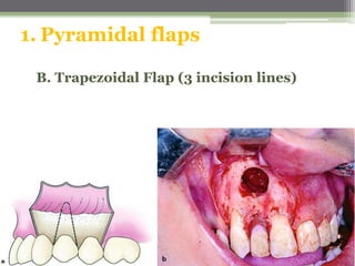 1. Pyramidal flaps
B. Trapezoidal Flap (3 incision lines)
 