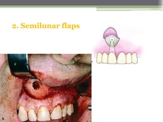 2. Semilunar flaps
 