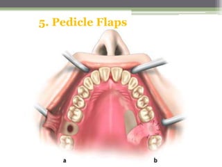 5. Pedicle Flaps
 