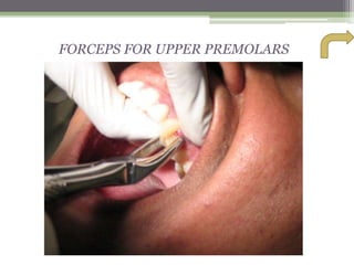 FORCEPS FOR UPPER PREMOLARS
 