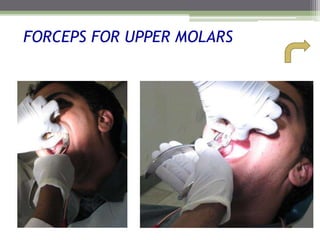 FORCEPS FOR UPPER MOLARS
 