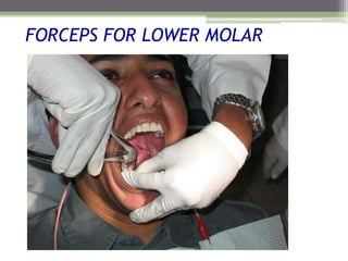 FORCEPS FOR LOWER MOLAR
 