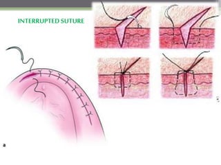 INTERRUPTED SUTURE
 