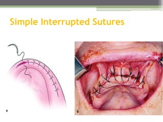 Simple Interrupted Sutures
 