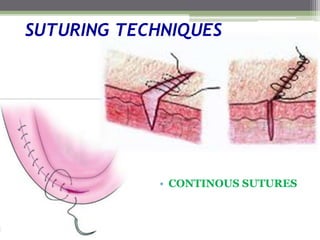 • CONTINOUS SUTURES
SUTURING TECHNIQUES
 