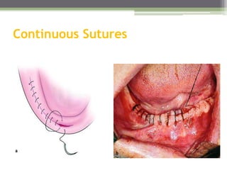 Continuous Sutures
 