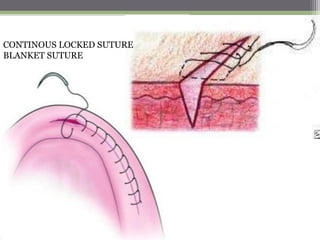 CONTINOUS LOCKED SUTURE
BLANKET SUTURE
 