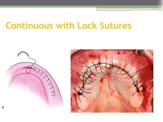 Continuous with Lock Sutures
 