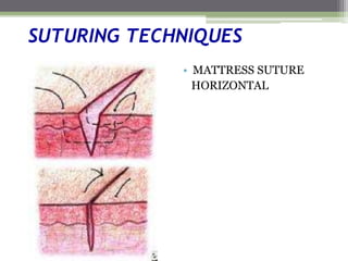 SUTURING TECHNIQUES
• MATTRESS SUTURE
HORIZONTAL
 