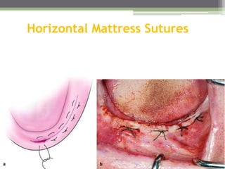 Horizontal Mattress Sutures
 