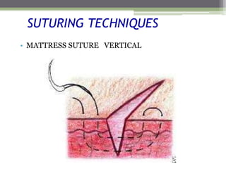 SUTURING TECHNIQUES
• MATTRESS SUTURE VERTICAL
 