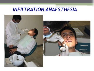 INFILTRATION ANAESTHESIA
 