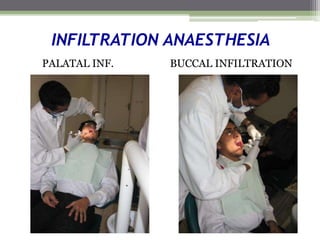 INFILTRATION ANAESTHESIA
PALATAL INF. BUCCAL INFILTRATION
 