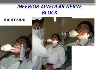 INFERIOR ALVEOLAR NERVE
BLOCK
RIGHT SIDE
 