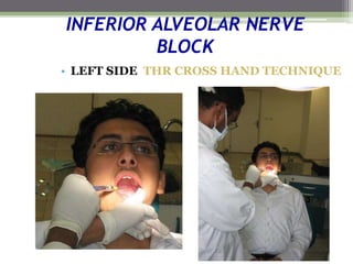 INFERIOR ALVEOLAR NERVE
BLOCK
• LEFT SIDE THR CROSS HAND TECHNIQUE
 