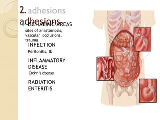 2.
adhesions
⚫ ISCHAEMIC AREAS
sites of anastomosis,
vascular occlusions,
trauma
INFECTION
Peritonitis, tb
INFLAMMATORY
DISEASE
Crohn’s disease
RADIATION
ENTERITIS
 