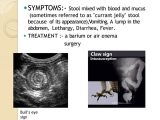 ⚫SYMPTOMS:- Stool mixed with blood and mucus
(sometimes referred to as "currant jelly" stool
because of its appearance),Vomiting, A lump in the
abdomen, Lethargy, Diarrhea, Fever.
⚫ TREATMENT :- a barium or air enema
surgery
Bull’s eye
sign
 