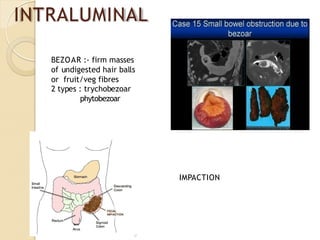 INTRALUMINAL
IMPACTION
BEZOAR :- firm masses
of undigested hair balls
or fruit/veg fibres
2 types : trychobezoar
phytobezoar
 