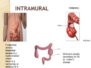 INTRAMURAL
Congenital
atresia
Intestinal
atresia is a
malformation
where
there is a
narrowing or
absence of a
malignancy
Stricture usually
secondary to Tb
or crohn’s
disease
 