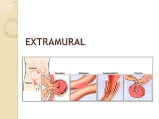 EXTRAMURAL
 