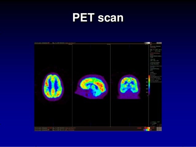 Surgery diet-epilepsy-9.11