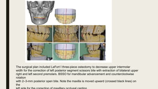 Surgery first orthognathic approach | PPTX