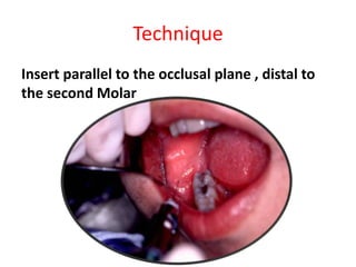 Technique
Insert parallel to the occlusal plane , distal to
the second Molar
 